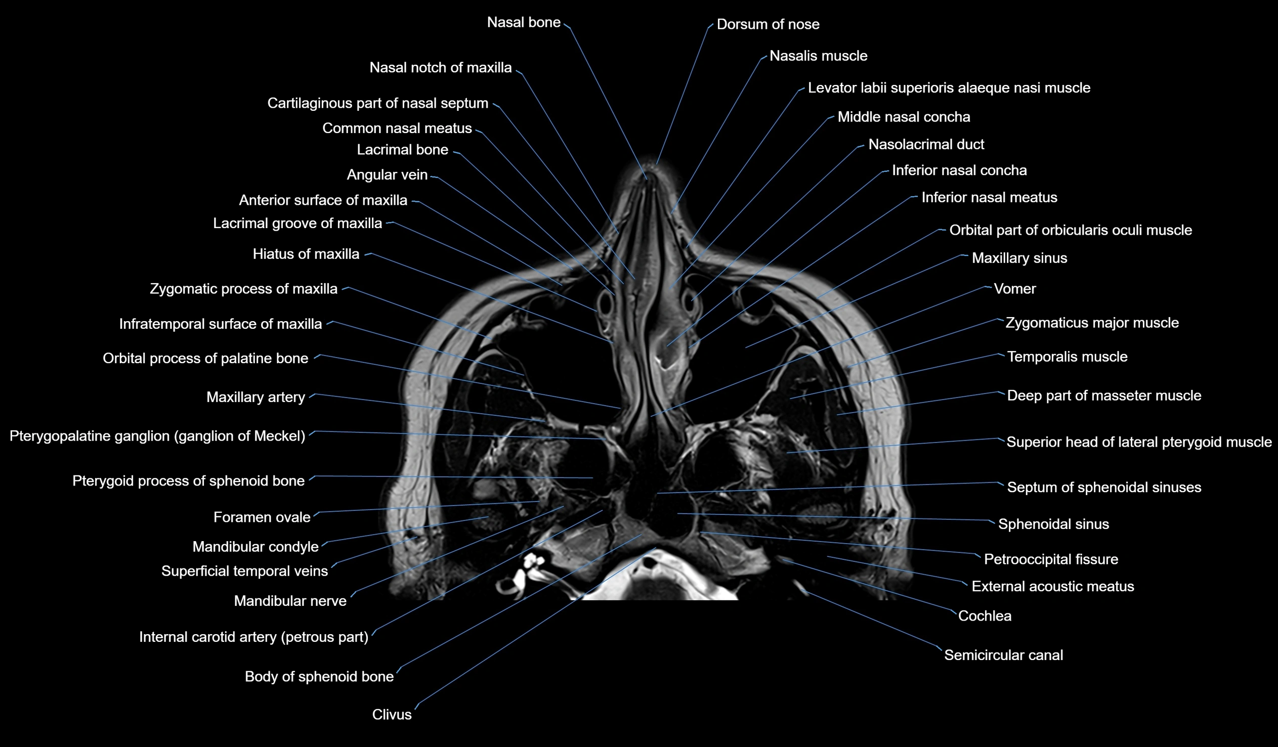 MRI face & paranasal sinuses(PNS) labelled  axial  cross sectional anatomy 3T radiology  image -00013.webp